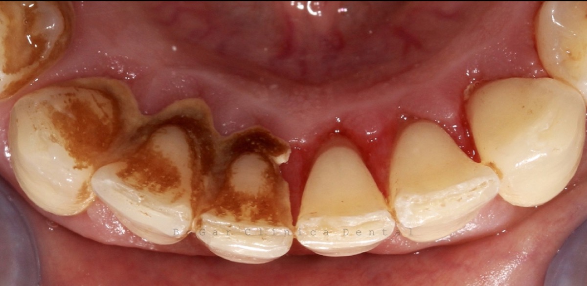 Periodoncia